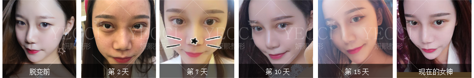 再也不用天天贴了，双眼皮美美哒