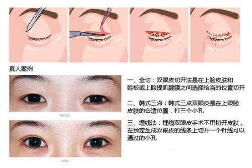 永康整形医院双眼皮术后能维持多久