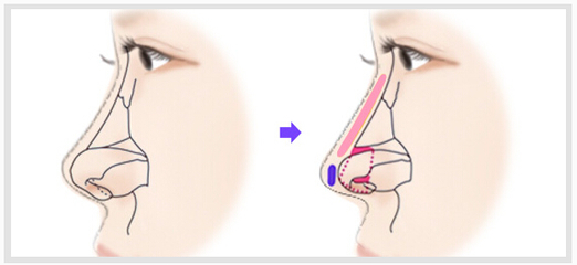 假体隆鼻会发生排异反应吗？光大专家告诉你！