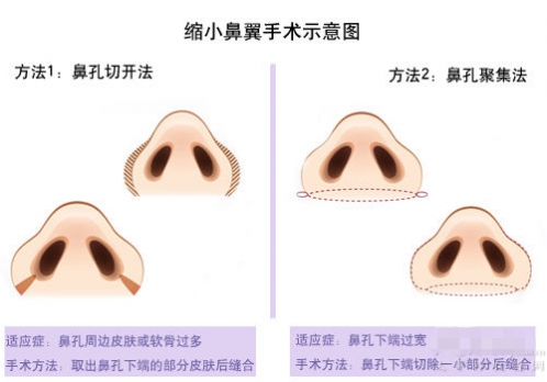 鼻翼缩小的效果怎么样？