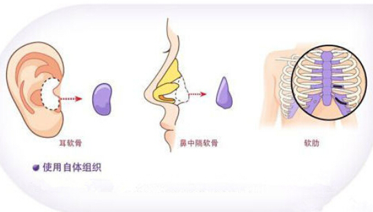 自体隆鼻是什么？