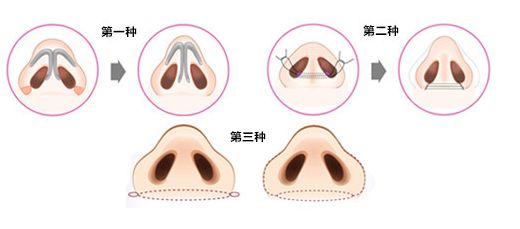 鼻孔缩小有什么方法？