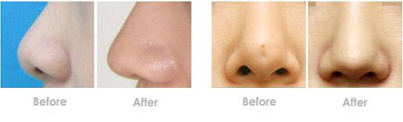 鼻尖整形术通常是怎么做的？