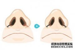 永康假体隆鼻大概需要多少钱